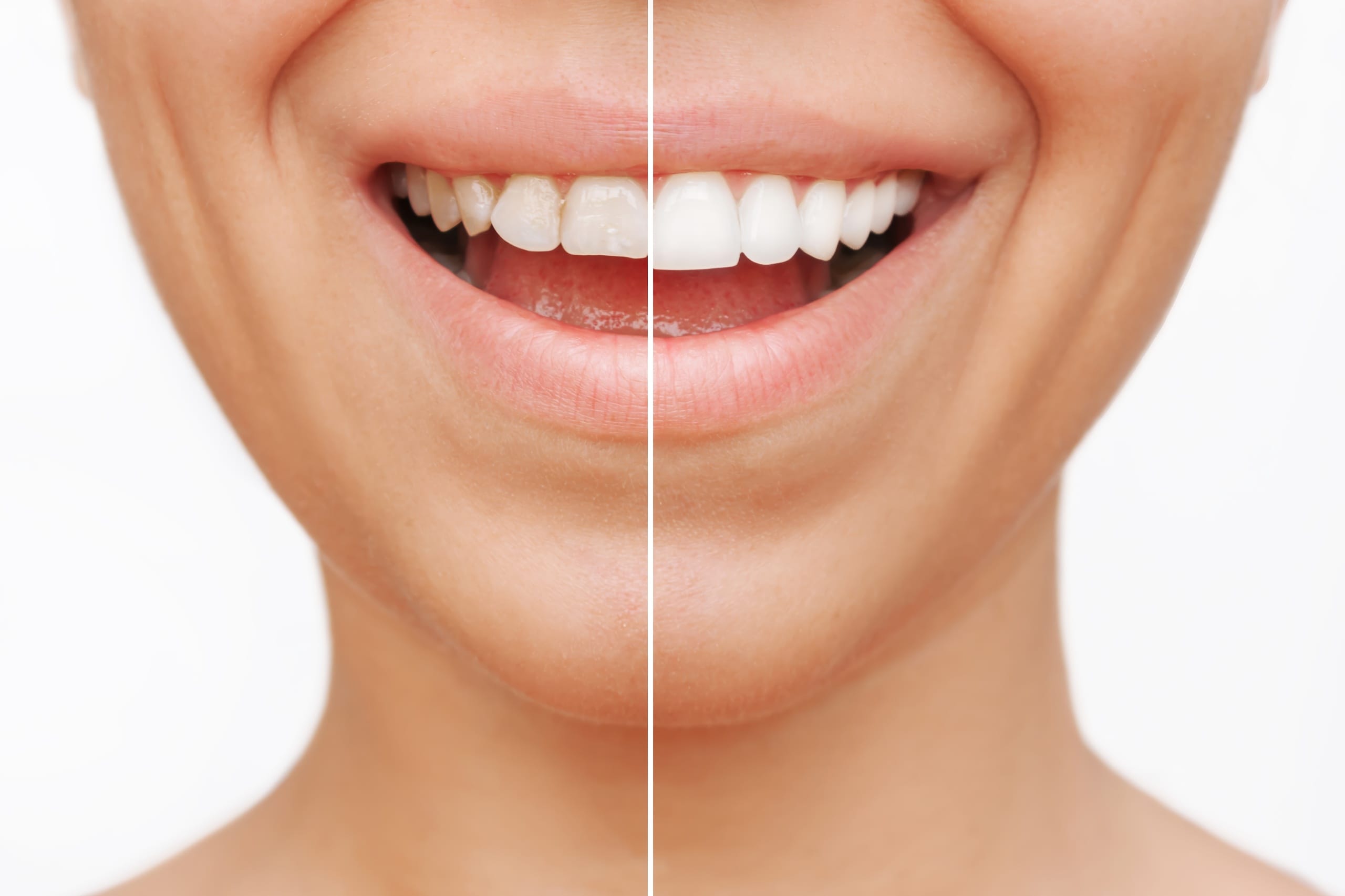 Close-up of a smiling mouth showing a side-by-side comparison of teeth before and after dental veneers—left side with stained, uneven teeth and right side with bright, straight teeth.