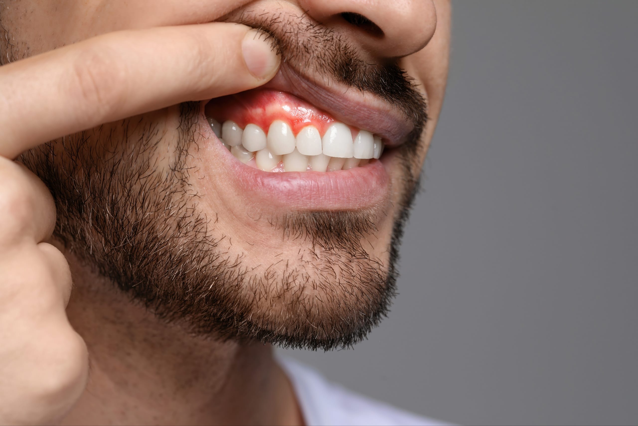 Gum Injury Close-up of a man pulling up his upper lip to reveal red, swollen gums above his front teeth, indicating a possible gum injury or inflammation.