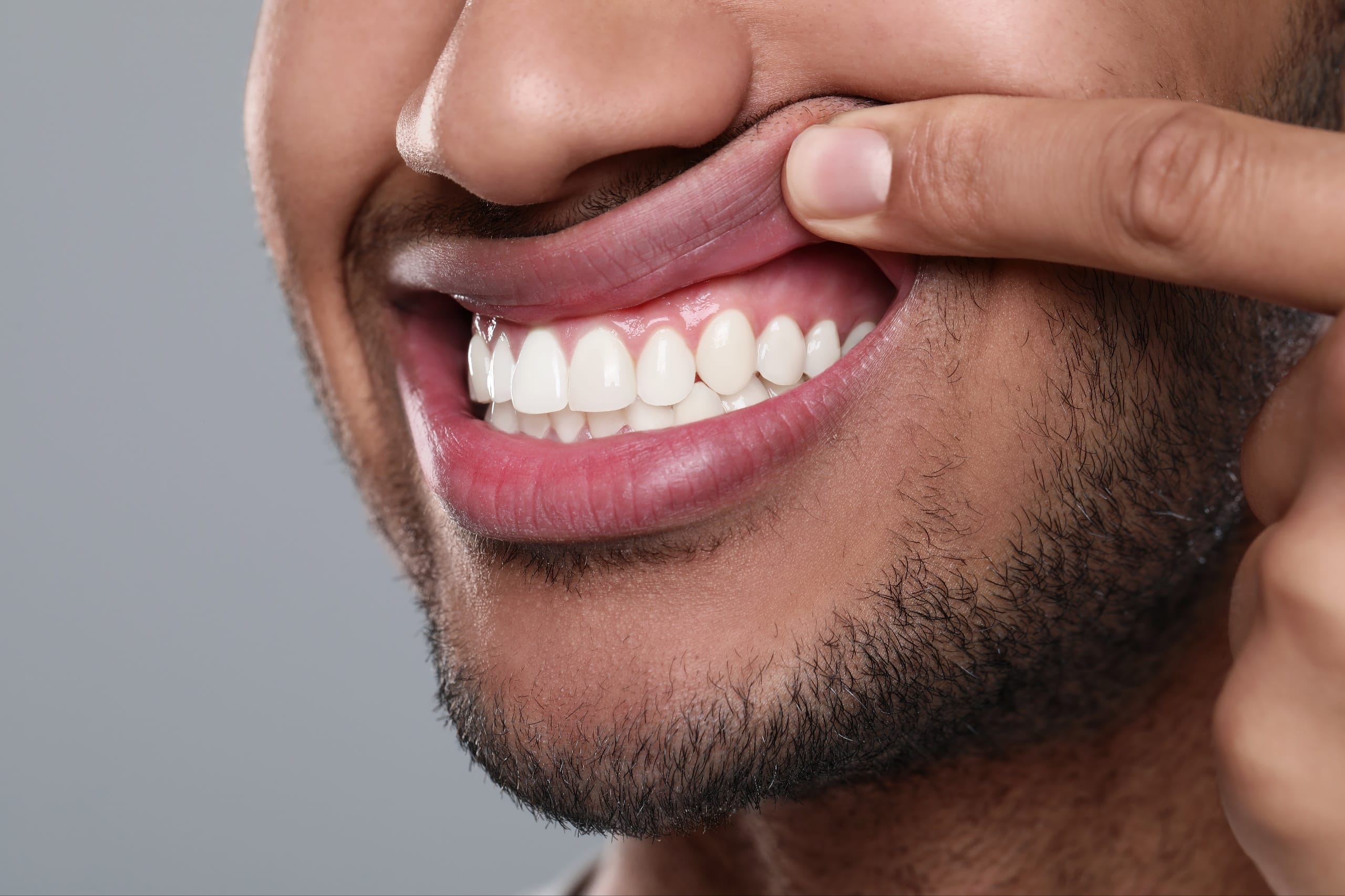 Close-up of a smiling man pulling up his upper lip to reveal healthy gums and straight white teeth, highlighting a gummy smile.