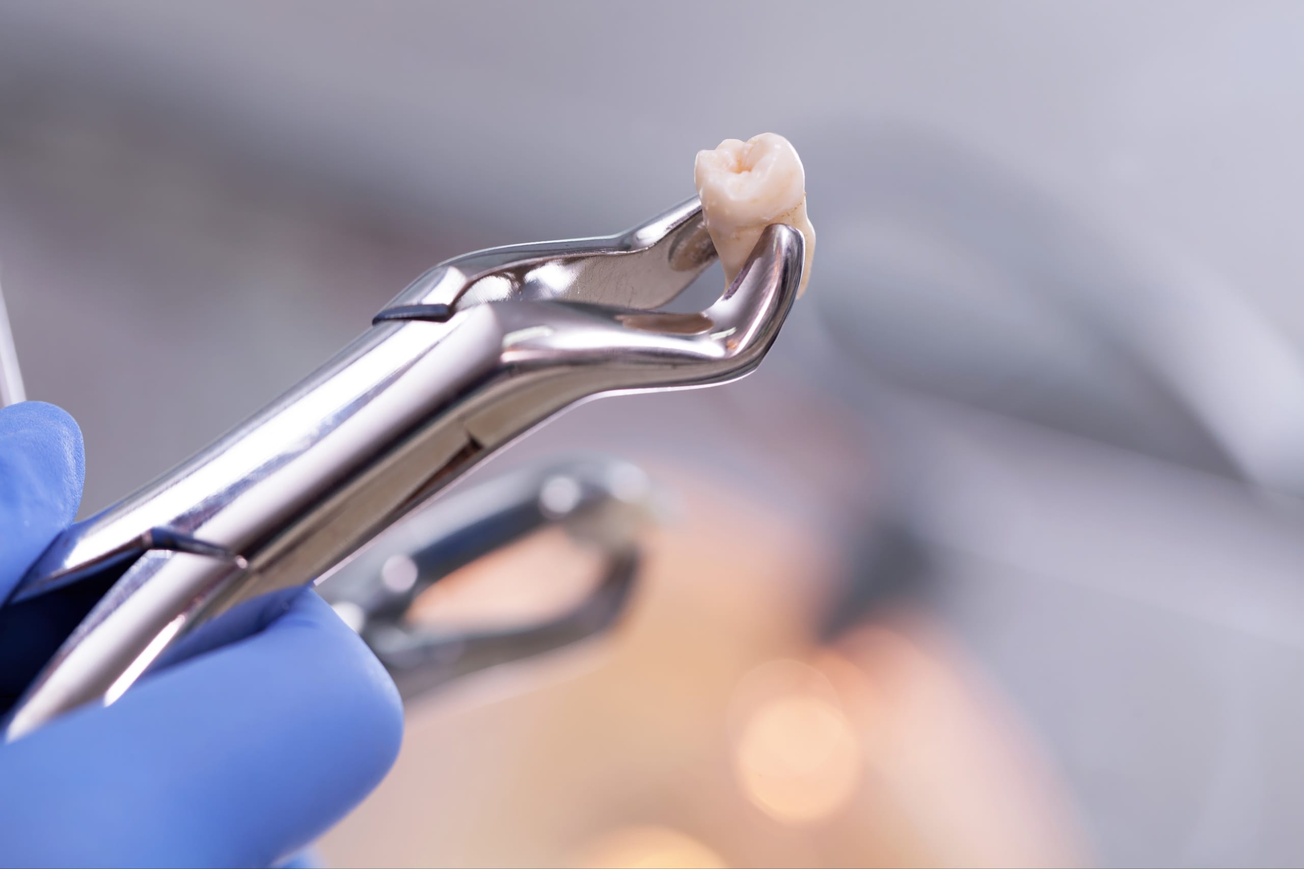 Close-up of dental forceps holding an extracted tooth, illustrating a recent tooth extraction procedure.
