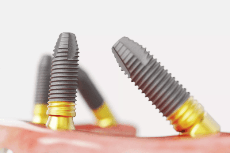 All-on-4 angled dental implants.