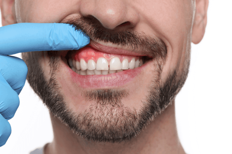A man lifting his upper lip to show red, irritated gum tissue above his front teeth.