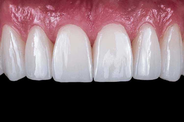 A detailed close-up of upper front teeth fitted with smooth, white porcelain veneers.