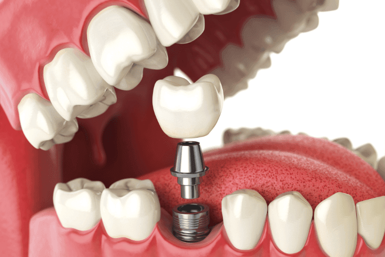 A 3D illustration showing a dental implant with the crown, abutment, and implant post aligned for placement in the gum.