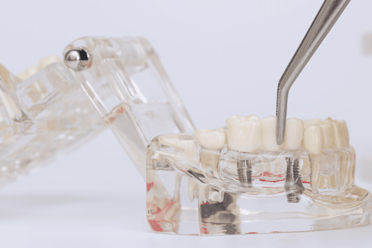 Placing the dental crown over dental implants.