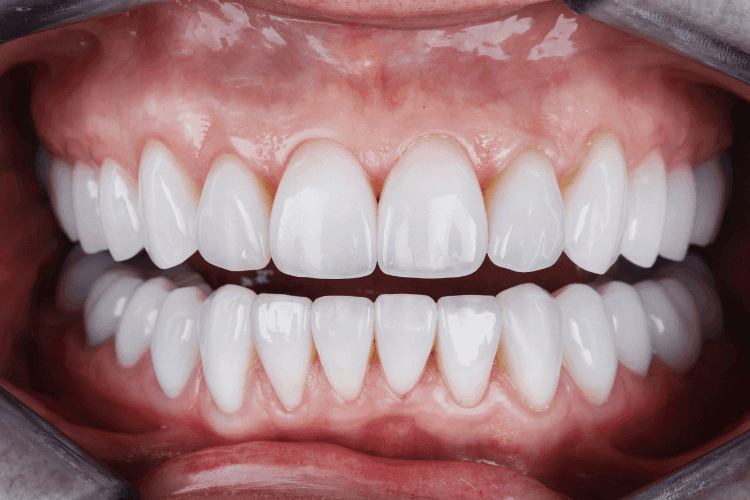 A close-up view of upper and lower teeth with bright, even dental veneers.