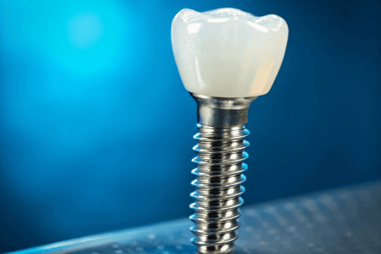 Close-up of a dental implant showing the implant post, abutment, and dental crown.