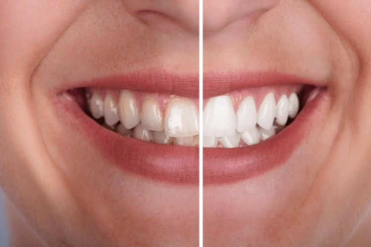 Before and after comparison of teeth whitening results on a smile.