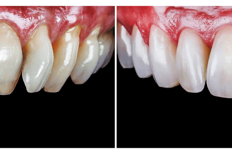 Before and after: Veneers improve the appearance of discolored and irregularly shaped teeth.