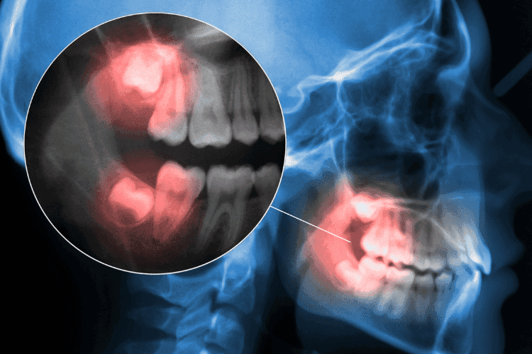 Dental X-ray highlighting wisdom teeth impaction.
