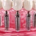 Can Seniors Get Full Mouth Dental Implants?