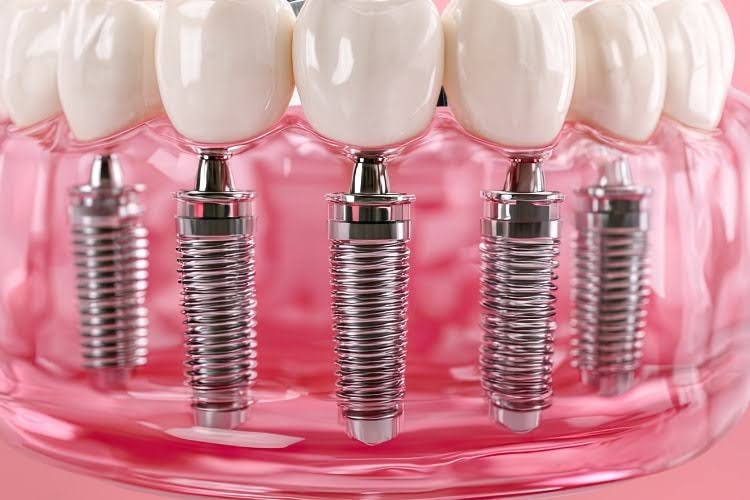 Can Seniors Get Full Mouth Dental Implants?