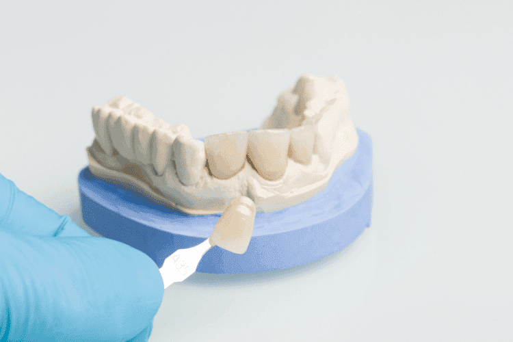Dental veneer shade matching on a tooth model.