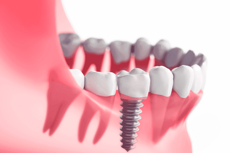Full mouth dental implants replace missing teeth using implant posts anchored in the jaw.