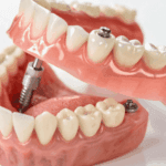Cost of Full Mouth Dental Implants: Your Complete 2026 Guide