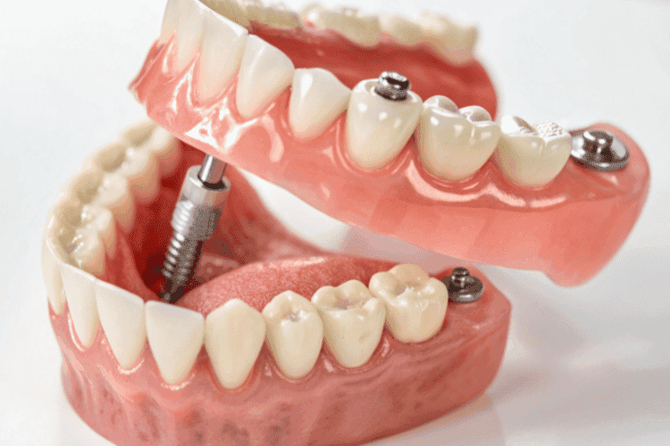 Cost of Full Mouth Dental Implants: Your Complete 2026 Guide