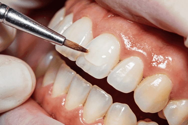 Veneers conceal cosmetic flaws such as chips and crooked teeth, contributing to a uniform smile.