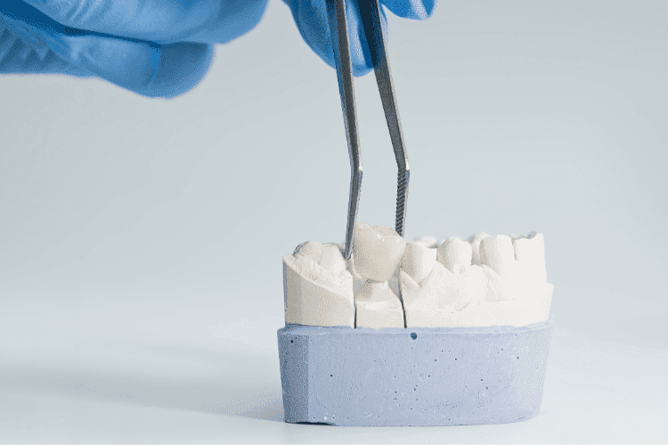 A dental bridge could be an alternative to dental implants.