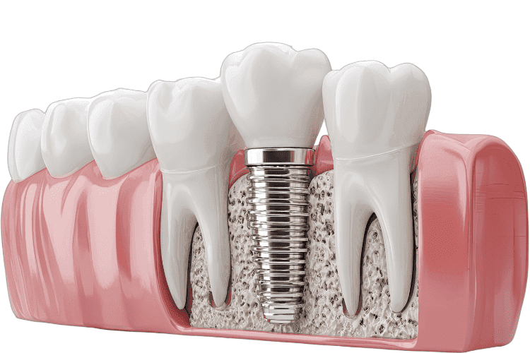 The new artificial tooth will blend in with the neighboring teeth.