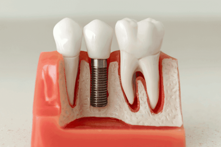 Cross-section model of a dental implant replacing a missing tooth.