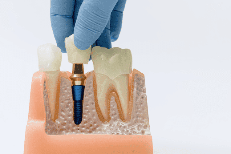 Dental implant procedure with crown fitted into the jaw model.