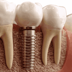 What Are Dental Implants? A Complete Guide for Tooth Replacement