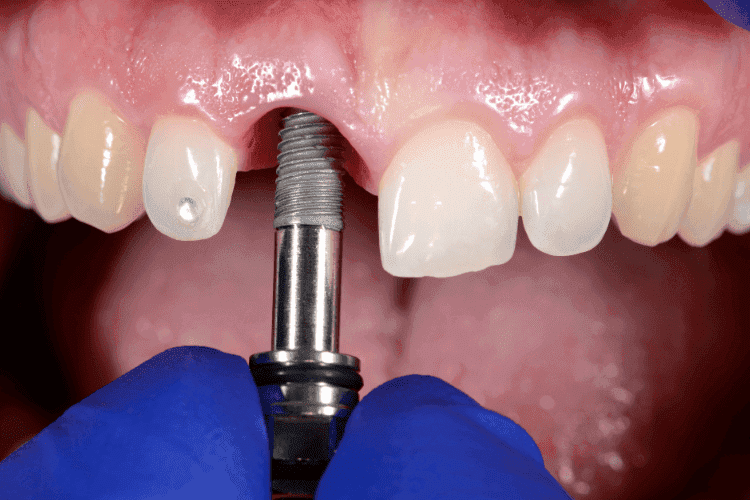 Dental implant screw positioned in the gum during tooth restoration procedure.