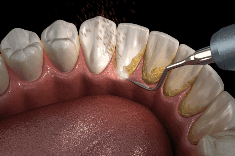 Your dentist removes plaque using special hand instruments.