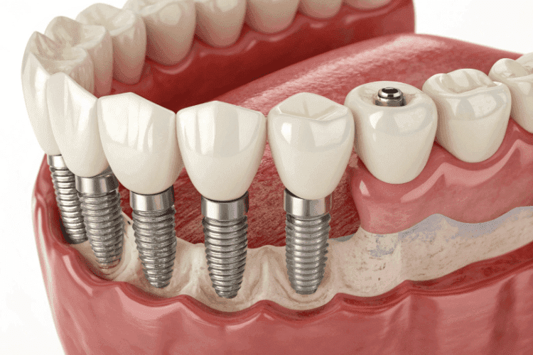 To be a candidate for dental implants, you must be free of active gum disease.