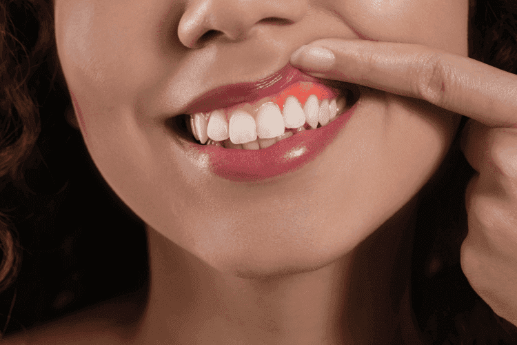 Patients must have healthy gums to be a candidate for dental implants.