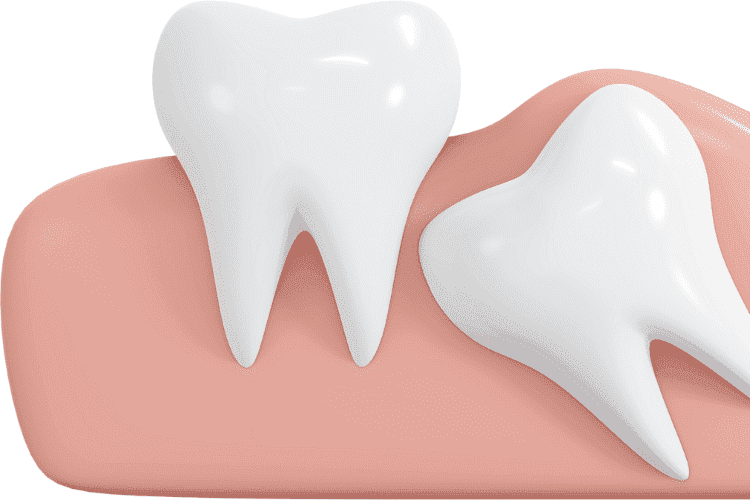 Many patients need wisdom tooth extractions due to impaction or crowding.