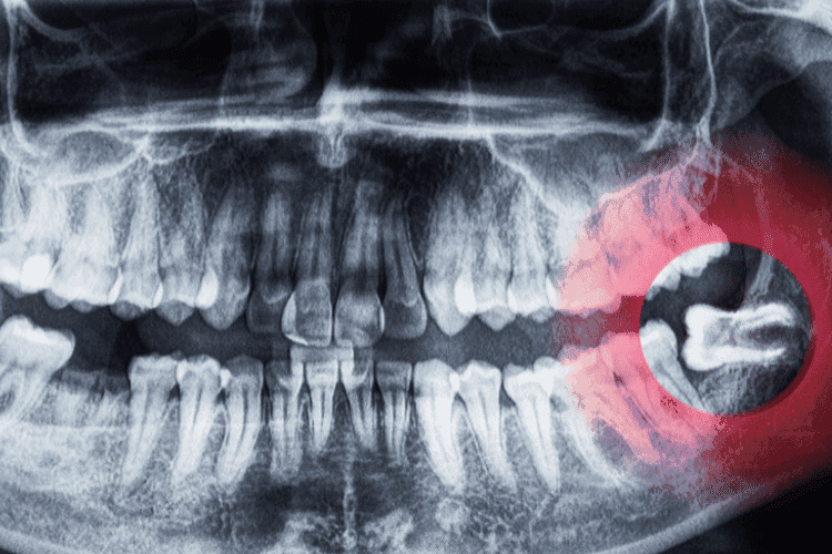 Panoramic dental X-ray showing impacted wisdom tooth.