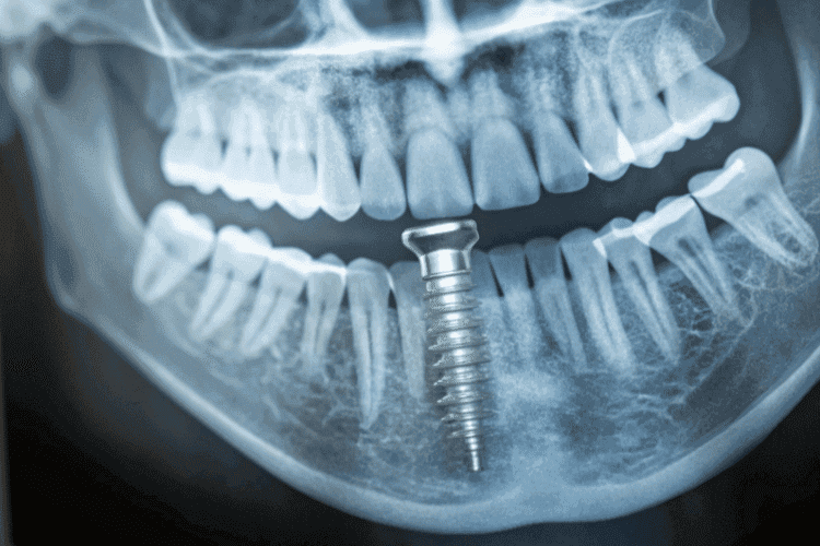 Panoramic dental X-ray highlighting an implant replacing a missing tooth.